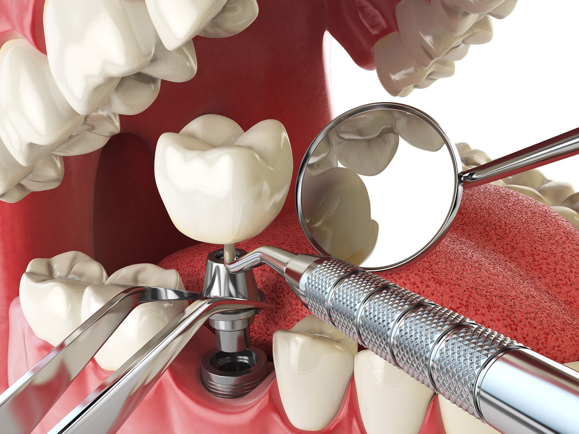  Implant Dental d'última generació